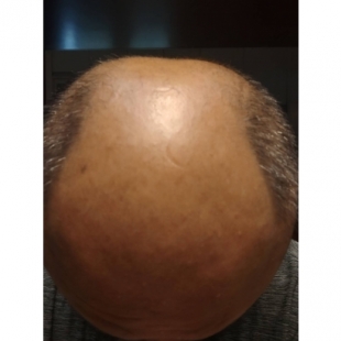 絲若雲的頭皮檢測系統